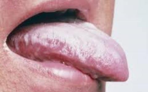 مقاله علمی تاثیر عسل بر موکوزیت دهانی